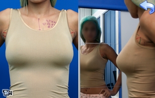 BioDynamic - chirurgia plastyczna powiększanie piersi